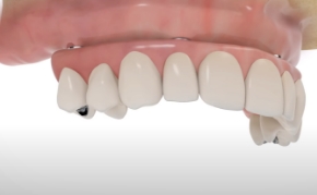 dental implants all-on-4