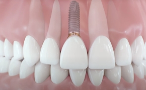 front tooth implants