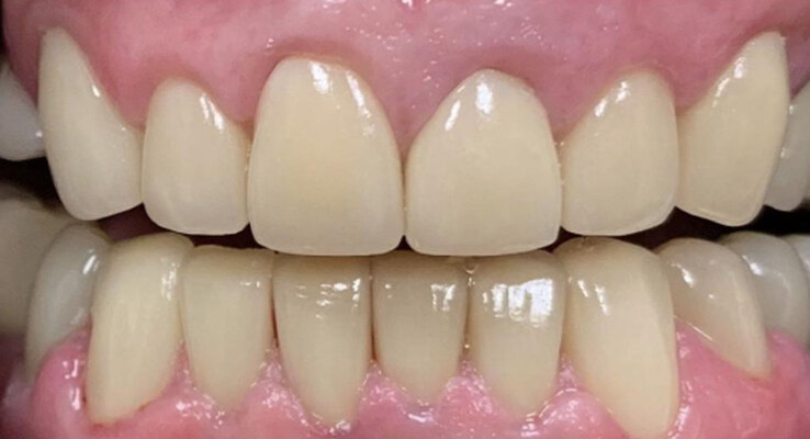 After Cosmetic Dentistry