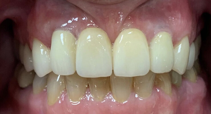 After Extractions Implants and Crowns