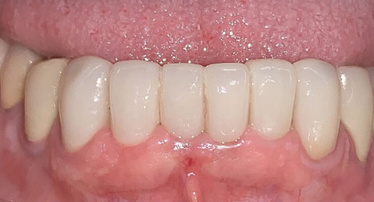 After Lower Anterior Crowns