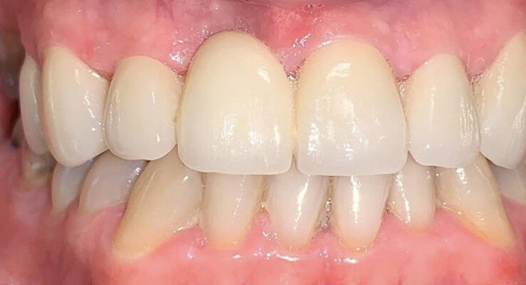 After Missing Teeth Replacement and Ceramic Restorations