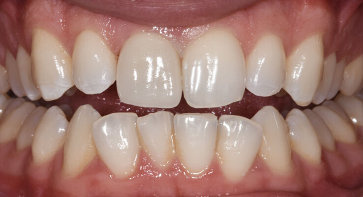 After Single Front Tooth Crown