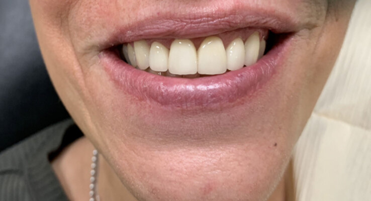 After Veneers Correcting an Occlusal Cant