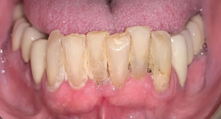 Before Lower Anterior Crowns