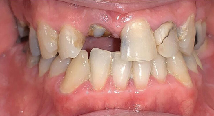 Before Missing Teeth Replacement and Ceramic Restorations