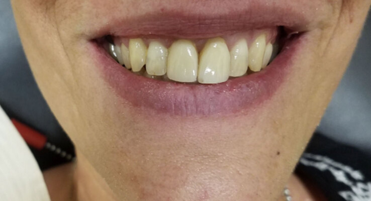 Before Veneers Correcting an Occlusal Cant