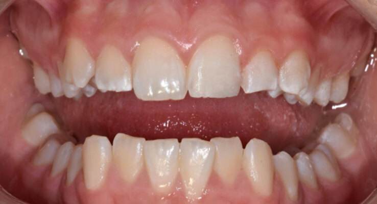 After Cosmetic Dentistry