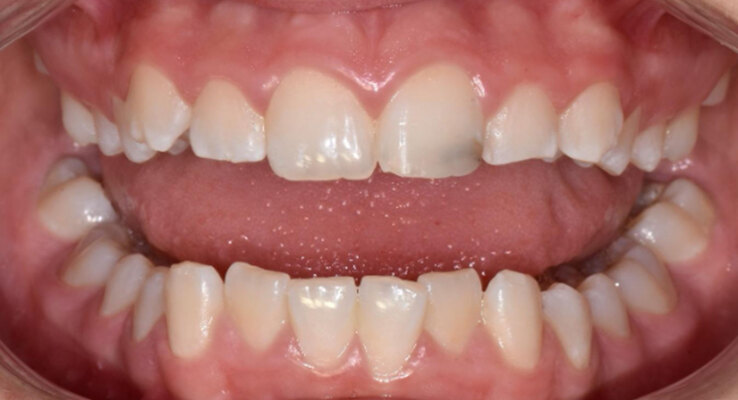 Before Cosmetic Dentistry