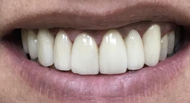 After Porcelain Veneer