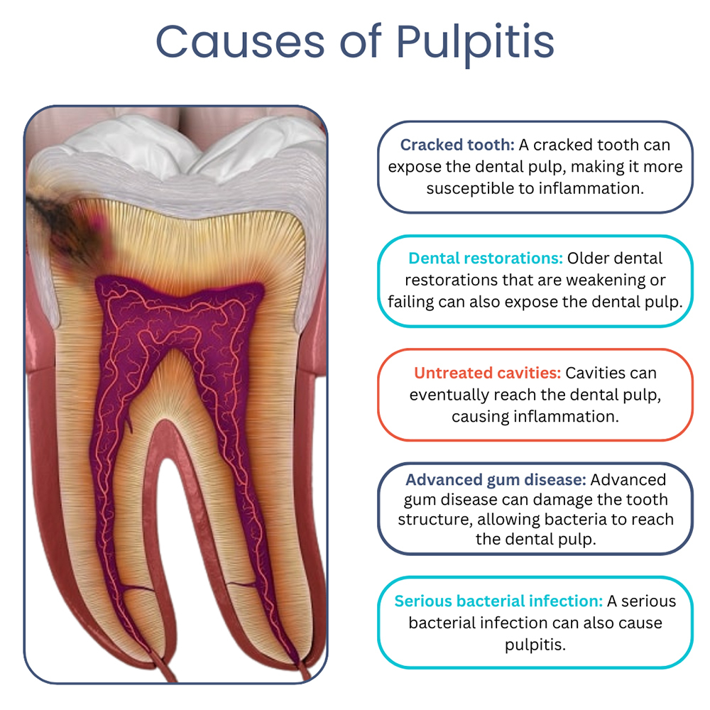 Causes of Pulpitis