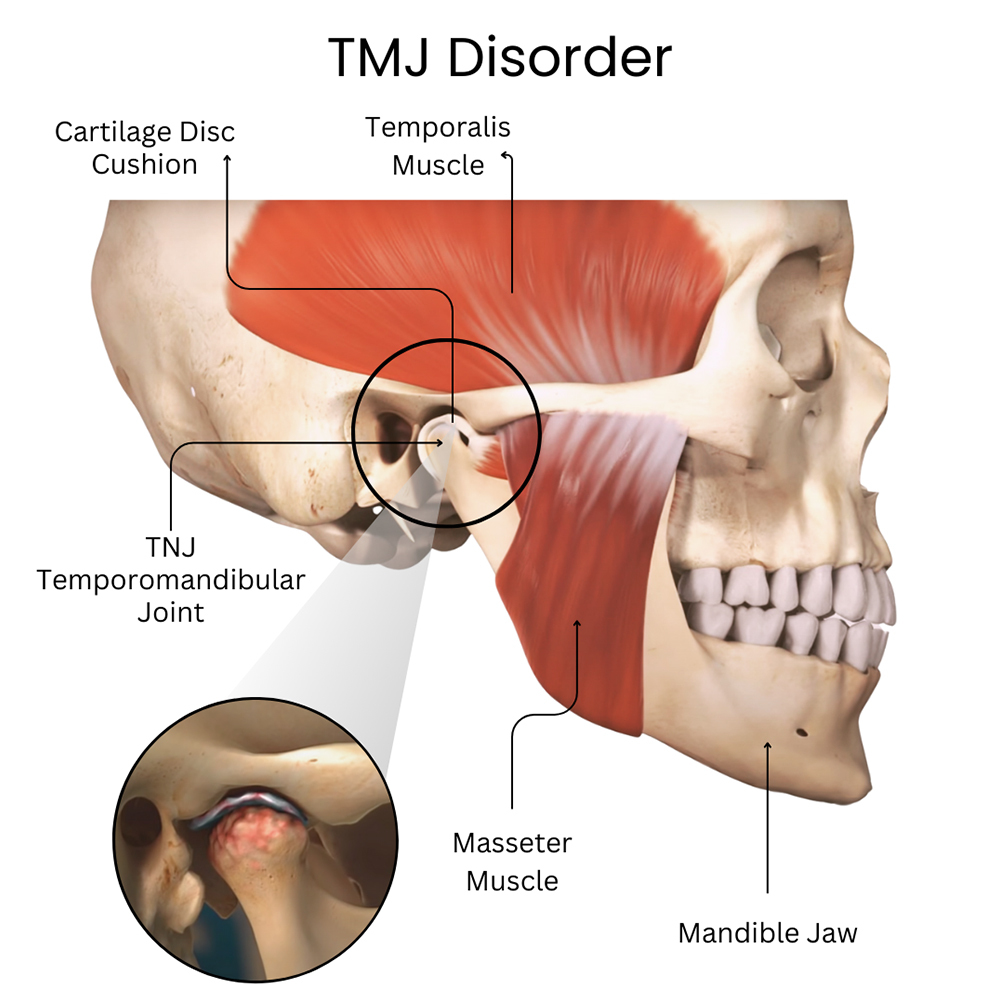 TMJ Disorder