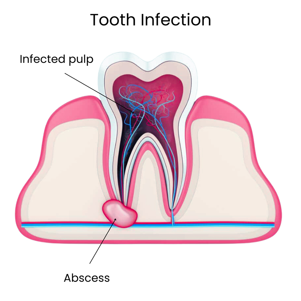 Tooth Infection