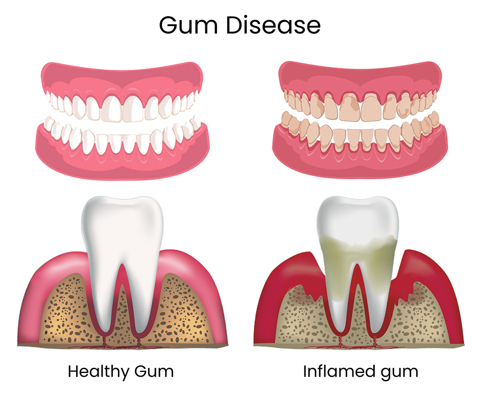 Gum Disease